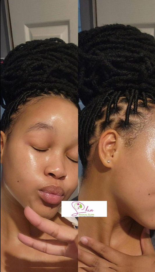 5-in-1 Acne & Dark Spot & Melasma Treatment Cream